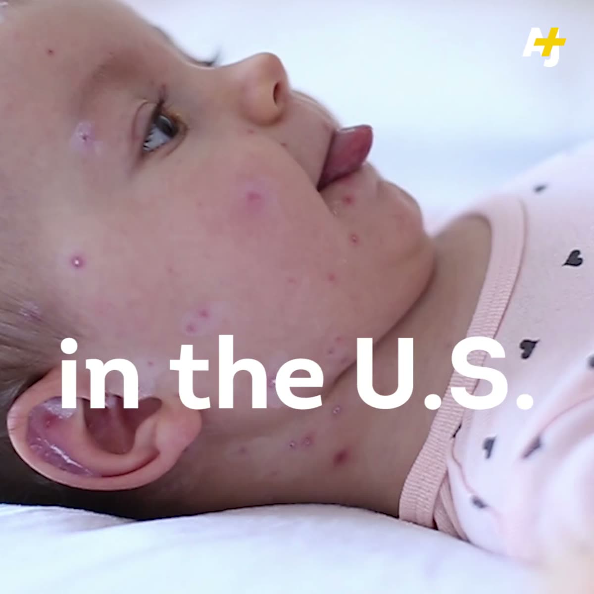 Opening frame of the measles explainer: an infant with measles